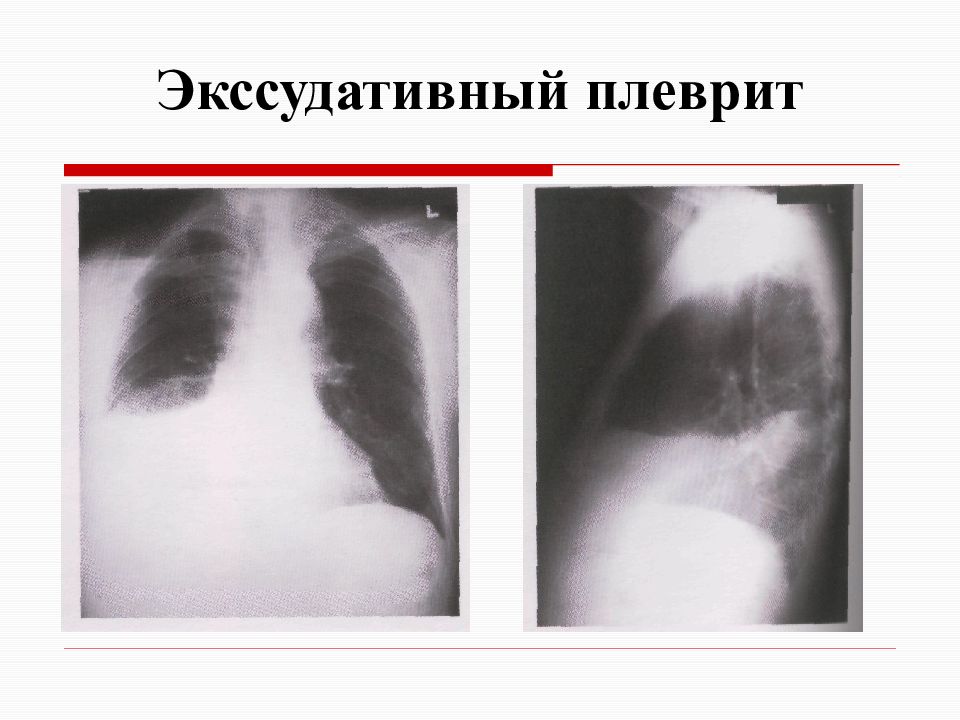 Экссудативный. Экссудативный плеврит рентгенограмма.