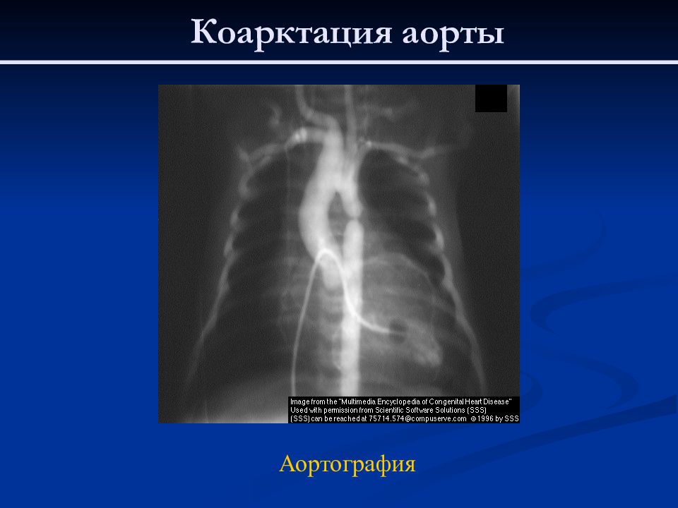 Коарктация аорты презентация