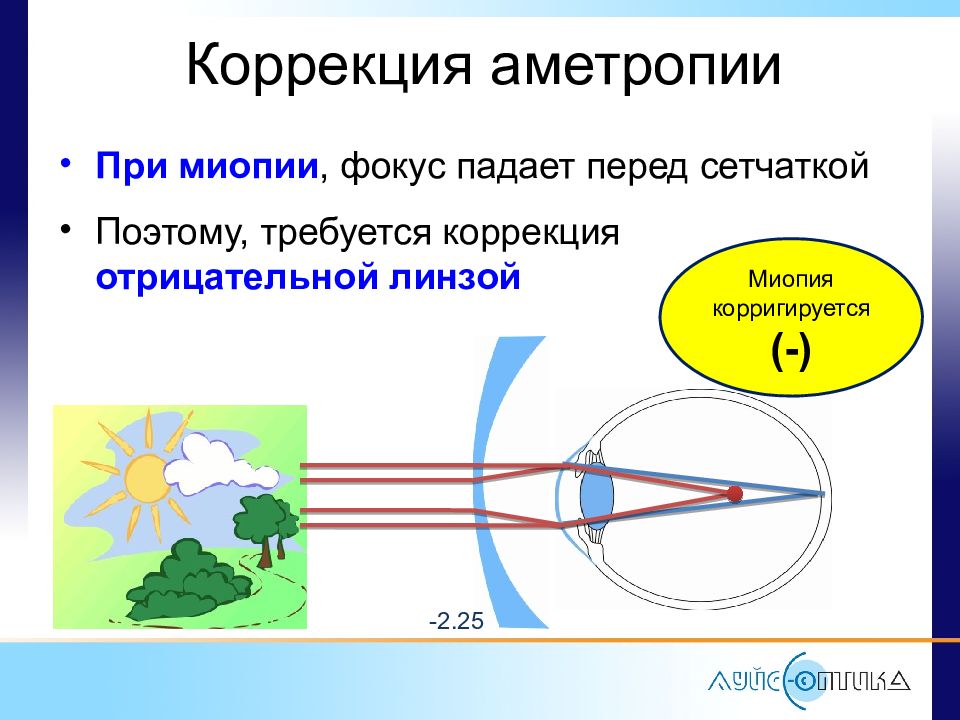 Фокус изображения при миопии