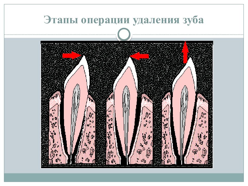 Стадии операция. Схема выдергивания зуба. Этапы операции удаления зуба.