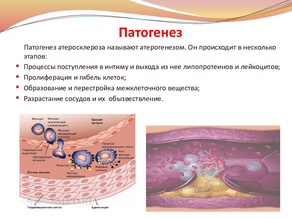 Атеросклероз этиология