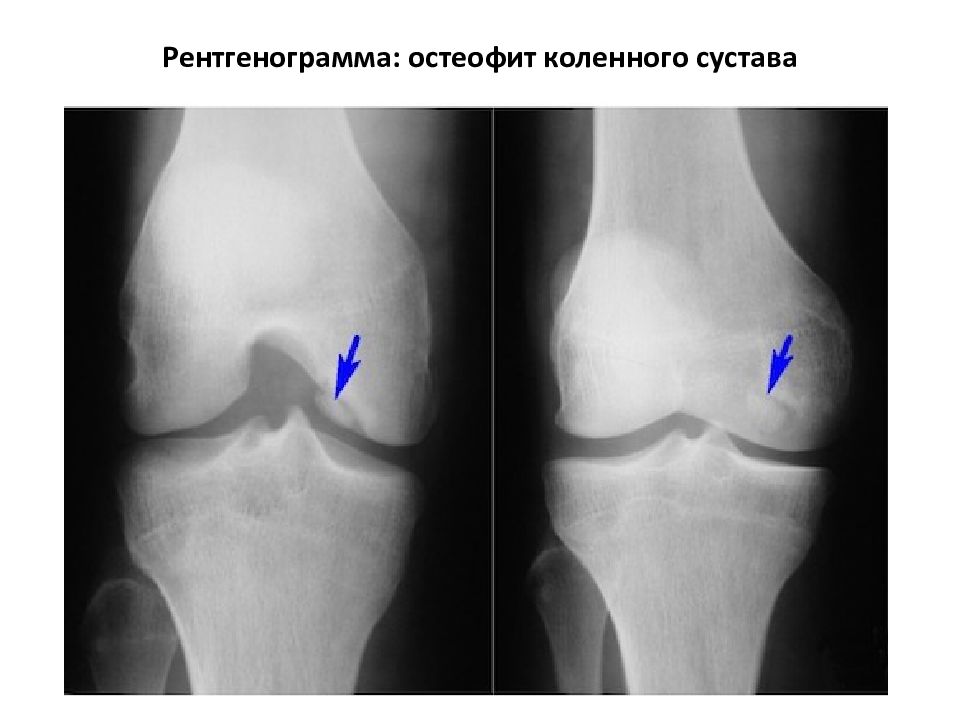 Хондромаляция бедренной и большеберцовой кости. Кенига болезнь коленного сустава на рентгене. Рассекающий остеохондрит рентген. Остеохондропатия Кенига. Артроз коленного сустава 2 степени рентген.