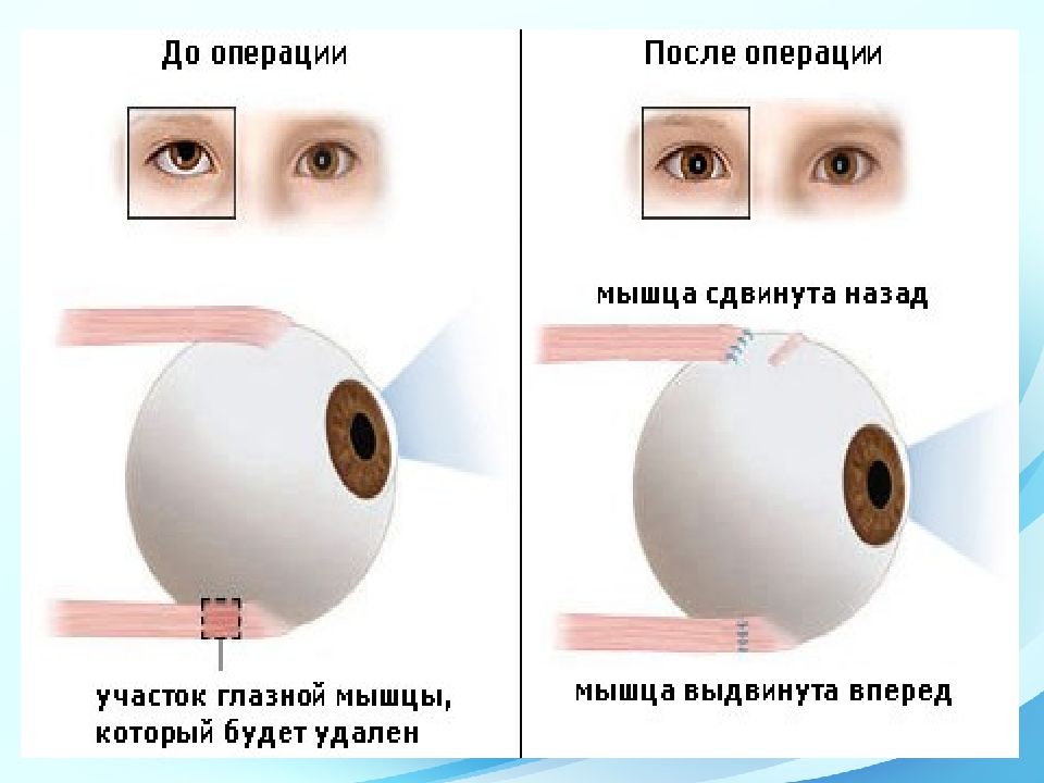 Патология глазодвигательного аппарата презентация