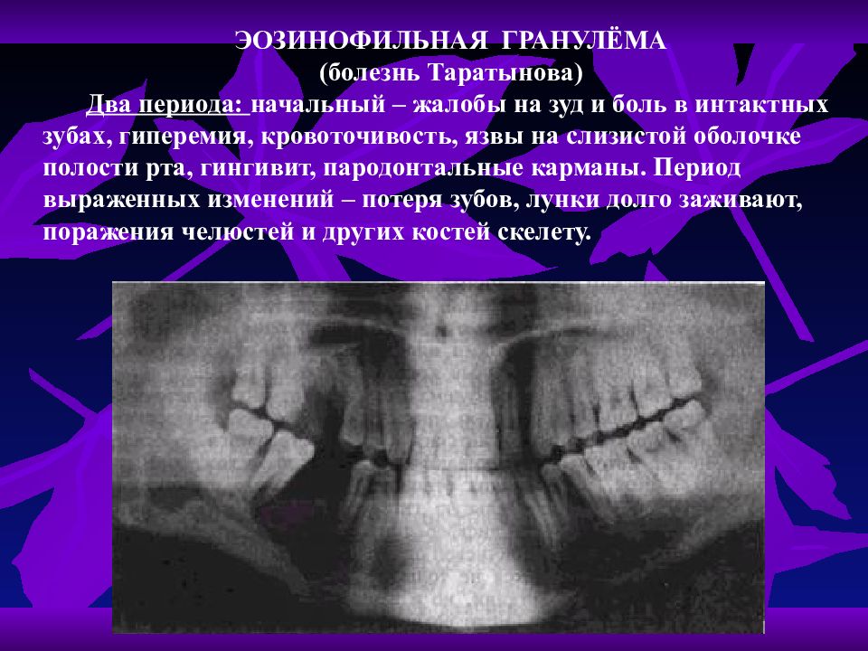 Идиопатические заболевания пародонта презентация