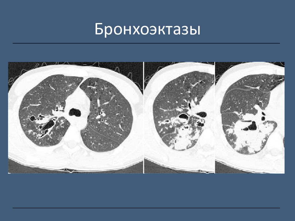 Тракционные бронхоэктазы. Цилиндрический бронхоэктаз. Цилиндрические бронхоэктазы.