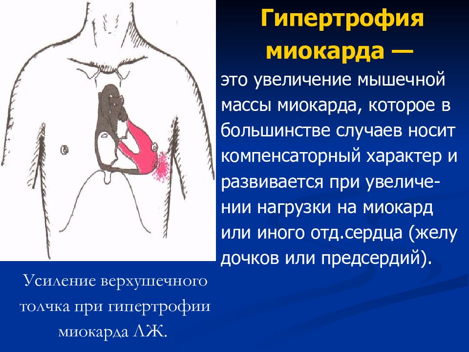 Верхушечный толчок при гипертрофии. Увеличение верхушечного толчка. усиление верхушечного толчка. верхушечный толчок усилен при.