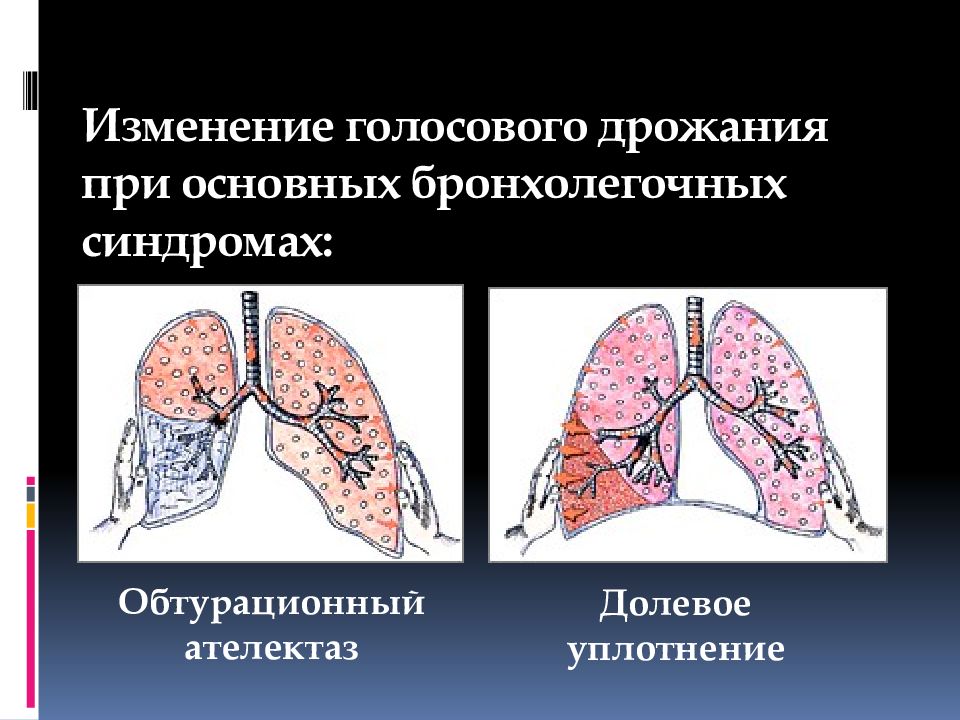 Голосовое дрожание. Обтурационный ателектаз синдром. Изменение голосового дрожания при основных легочных синдромах. Голосовое дрожание при основных бронхолегочный синдромах. Бронхолегочный синдром.