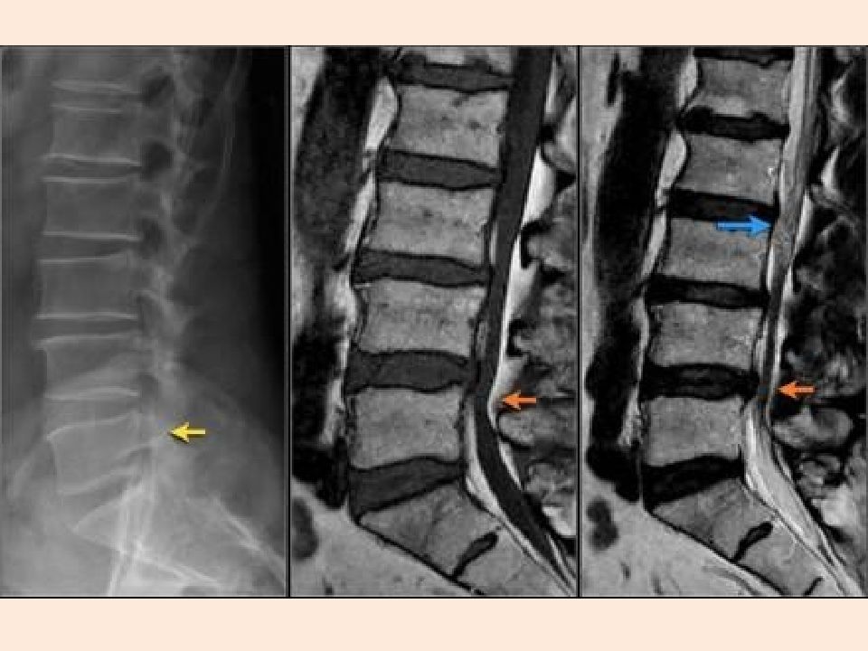 Абсолютный стеноз. Стеноз межпозвонковых отверстий l2-s1. Дегенеративный спинальный стеноз l3-l4. Спинальный стеноз поясничного отдела позвоночника. Спинальный стеноз с6-с7.