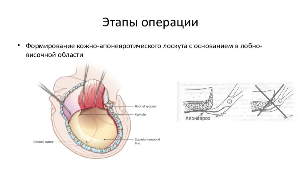 Этапы операции. Операция этапы операции. Кожно апоневротический лоскут. Формирование кожно-апоневротического лоскута.