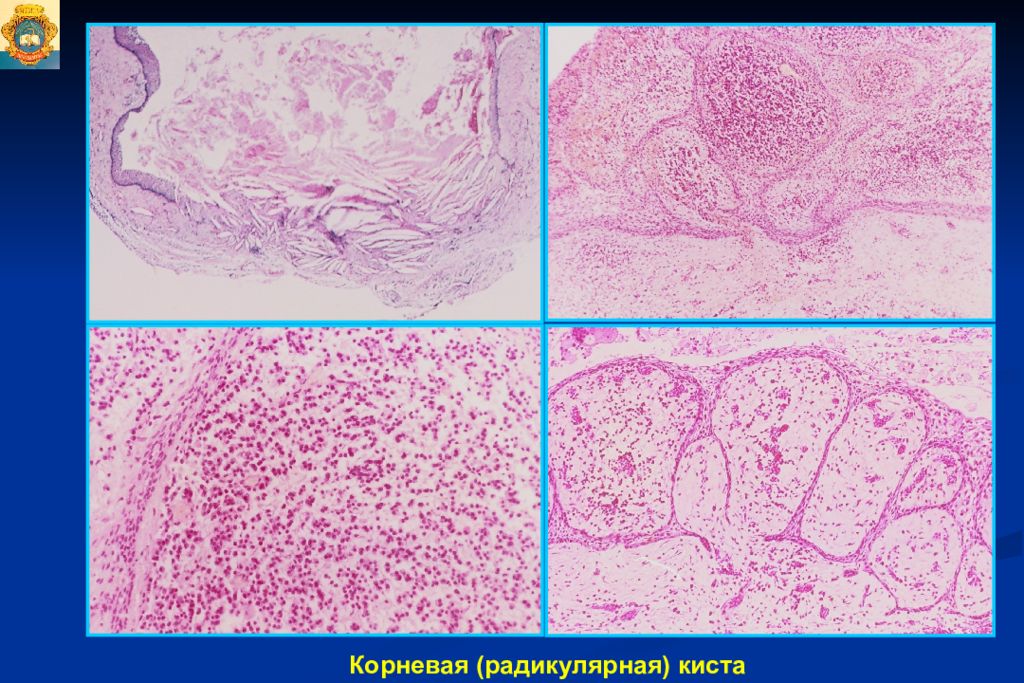 Микропрепарат стенка радикулярной кисты