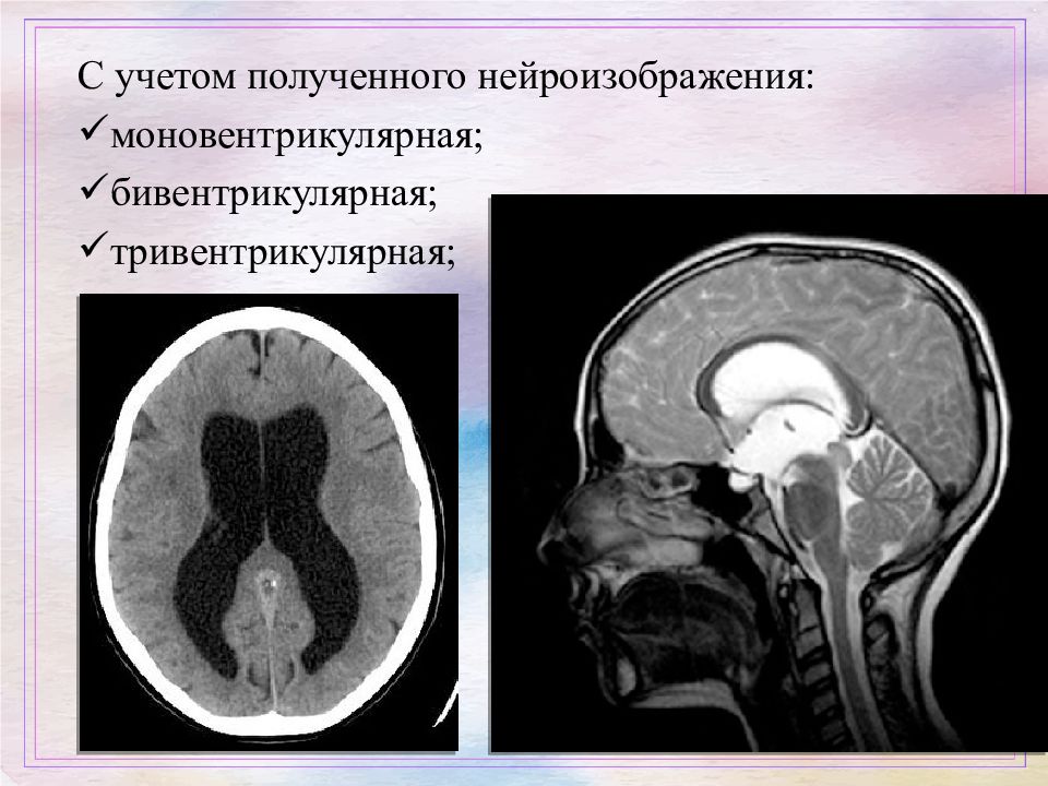 Виды гидроцефалии. Тетравентрикулярная гидроцефалия. Наружная гидроцефалия головного мозга кт. Окклюзионная гидроцефалия кт. Арезорбтивная гидроцефалия головного мозга.