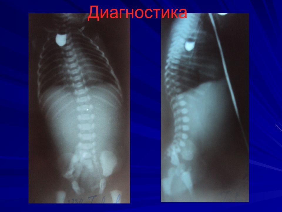 Атрезия пищевода. Эзофагеальная атрезия. Атрезия пищевода торакотомия. Атрезия пищевода клиническая картина. Атрезия пищевода проба Элефанта.