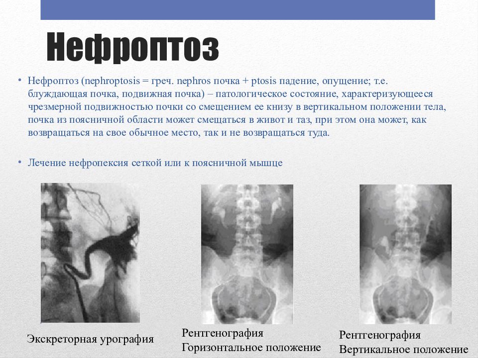 Нефроптоз что это