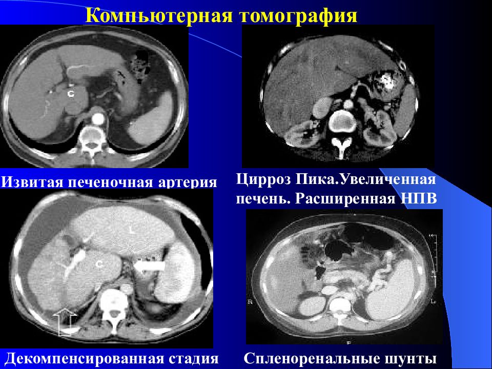 Кт картина цирроза печени