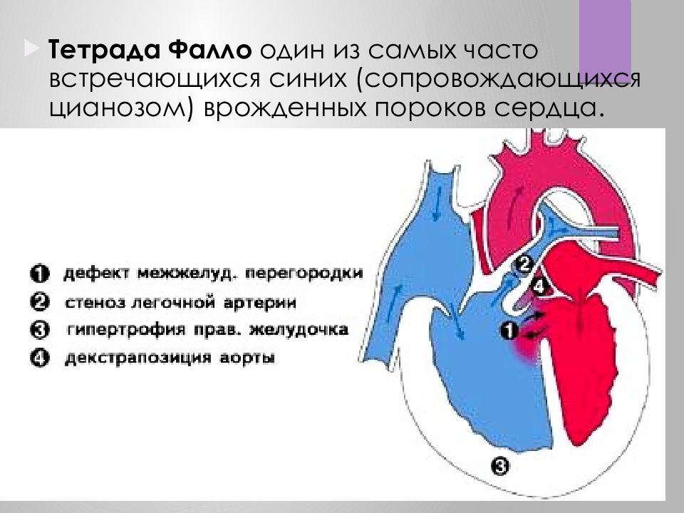 Врожденный порок сердца тетрада фалло презентация