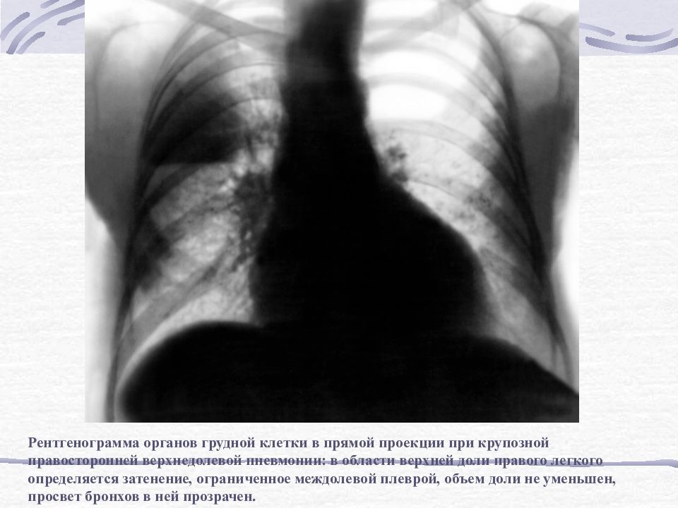 Рентген при пневмонии. Крупозная пневмония рентгенограмма. Рентген верхнедолевой пневмонии. Верхнедолевая пневмония рентгенограмма. Крупозная пневмония рентгенограмма грудной клетки.