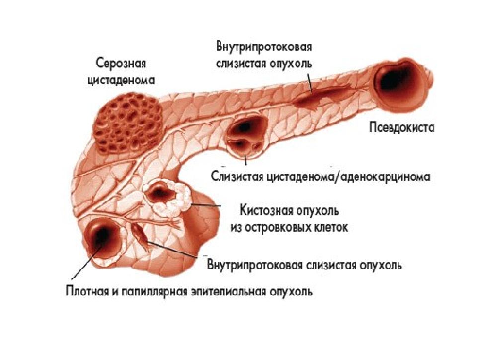 Рак хвоста поджелудочной. Кистозные образования поджелудочной железы классификация. Кистозные опухоли поджелудочной железы классификация. Истинная киста поджелудочной железы. Истинные кисты поджелудочной железы классификация.