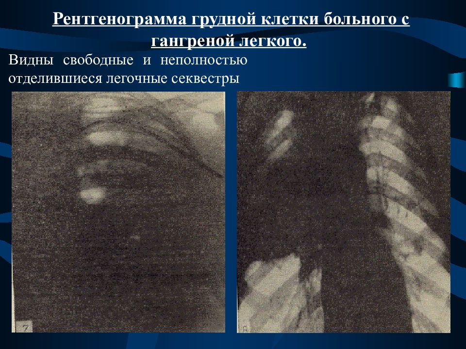 Нагноительные заболевания плевры. Рентгенография гангрены легкого. Нагноительные заболевания легких. Нагноительные заболевания легких рентгенограмма. Нагноительные заболевания легких и плевры.