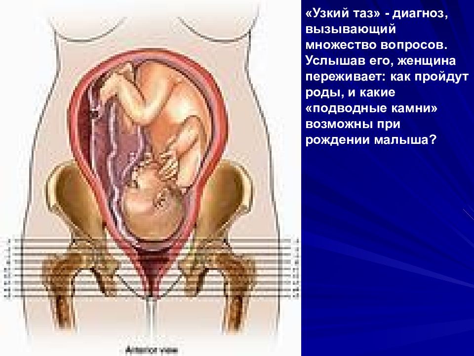 Узкий таз в акушерстве презентация