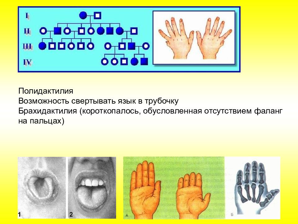 Презентация по биологии 8 класс наследственные и врожденные заболевания