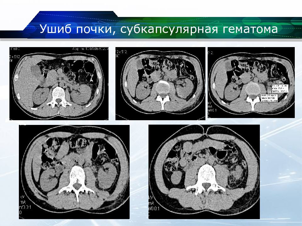 Организующая гематома