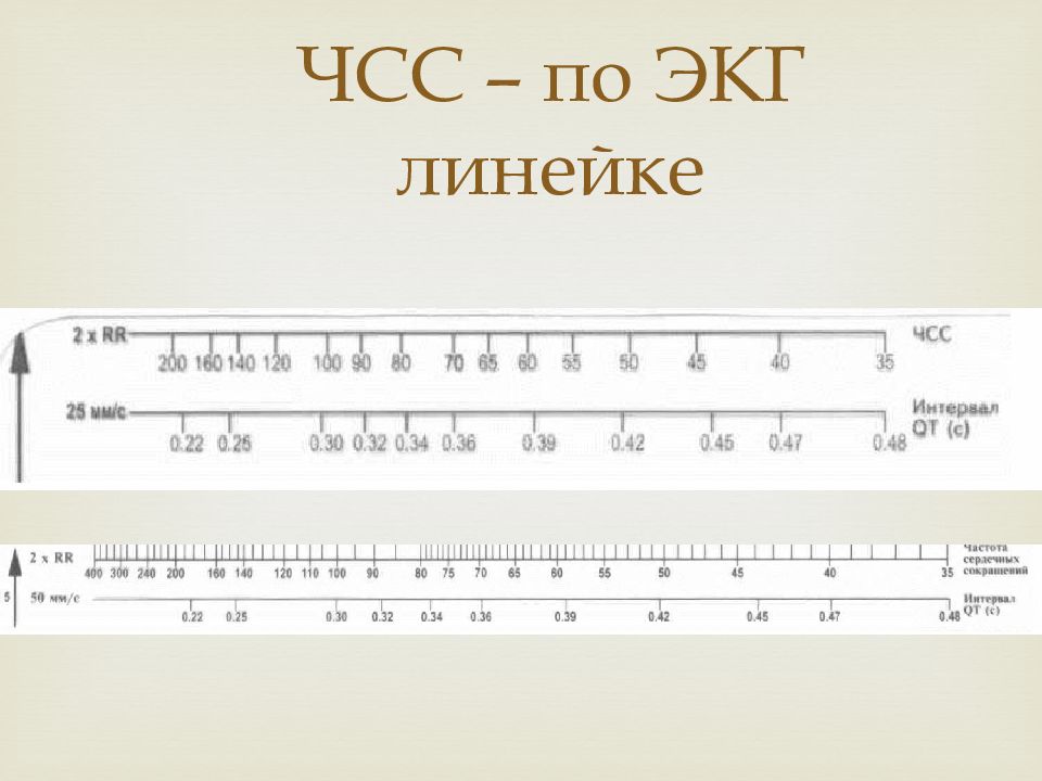 Как посчитать чсс на экг по клеточкам. Подсчёт ЧСС по ЭКГ 25 мм. Линейка для измерения ЧСС на ЭКГ. Линейка для подсчета ЧСС В ЭКГ. Измерение ЧСС по линейке на ЭКГ.