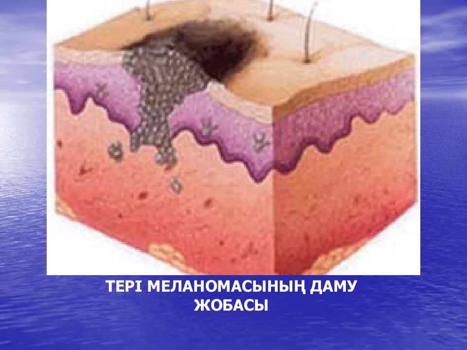 Поверхностные образования кожи. Базалиома (базальноклеточная эпителиома);. Эпидермально дермальный невус. Эпителиоидная меланома. Меланома поражения кожных покровов.