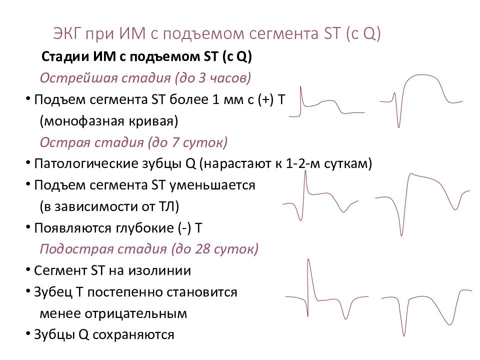 Экг синдромы при окс