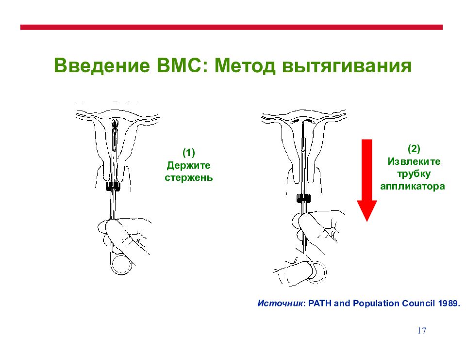 Вмс это. Методики введения спирали. ВМС спираль метод введения. Методика введения ВМС Мирена. Введение внутриматочной спирали.