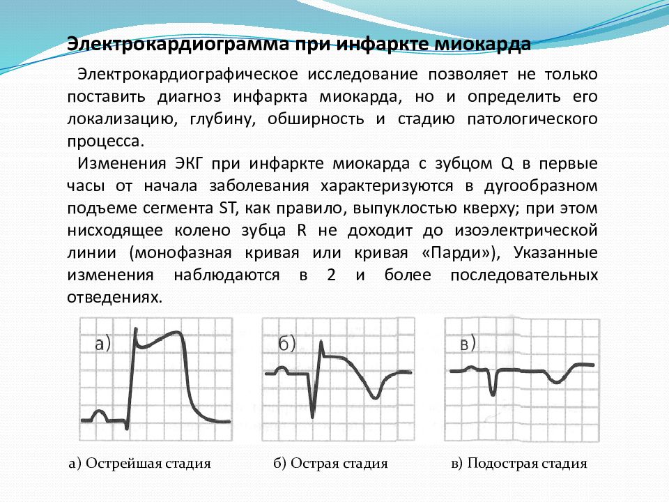 Экг признаки инфаркта миокарда. Изменения на ЭКГ остром инфаркте миокарда. Острая стадия инфаркта миокарда ЭКГ. Острая фаза инфаркта миокарда ЭКГ. ЭКГ при разных стадиях инфаркта миокарда.