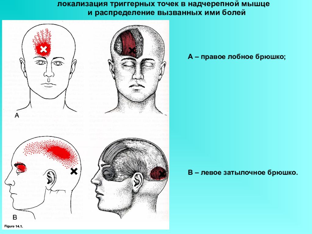 Схема как болит голова