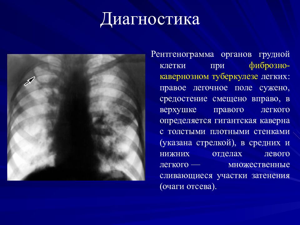 Презентация по фтизиатрии туберкулез