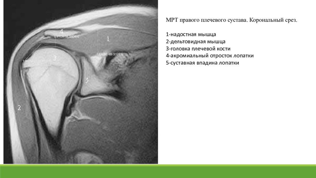 Мрт мышц плечевого сустава