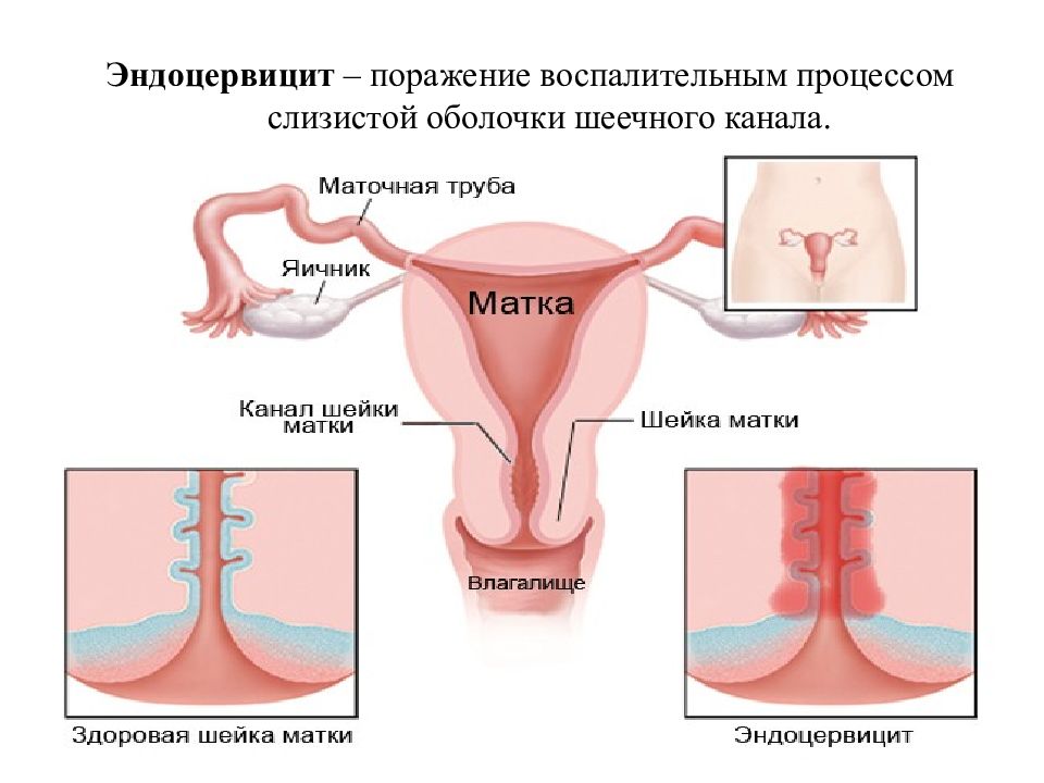 Экзоцервицит и эндоцервицит