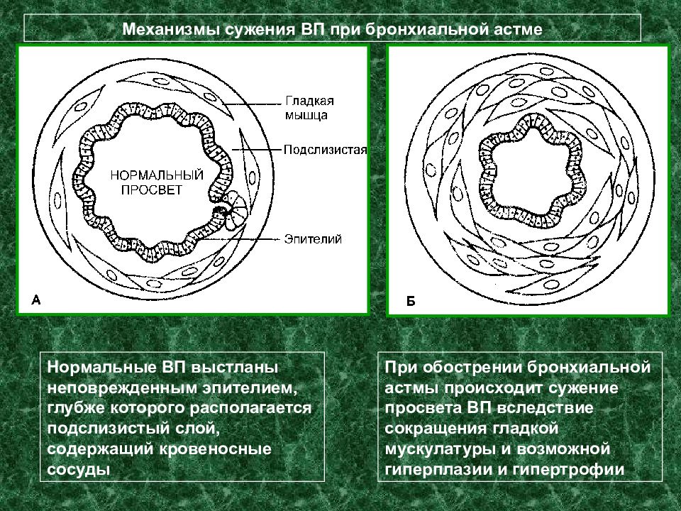 Эмфизема легких при бронхиальной астме. Сужается просвет при бронхиальной астме. Просвет бронхов при астме. Бронхиальная астма и эмфизема легких.