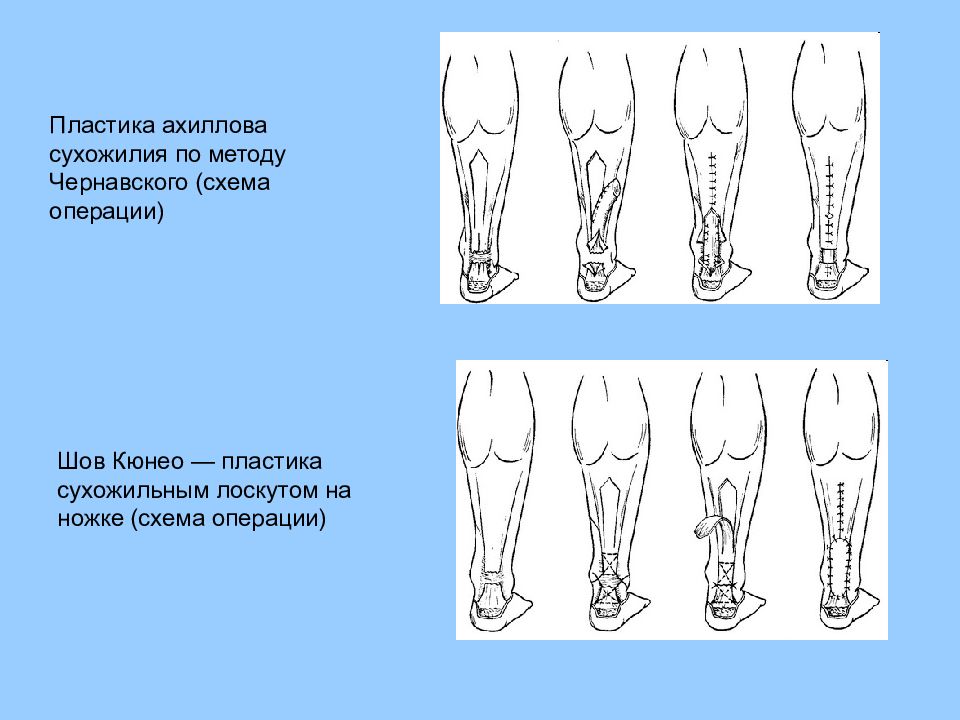 Презентация операции на сухожилиях