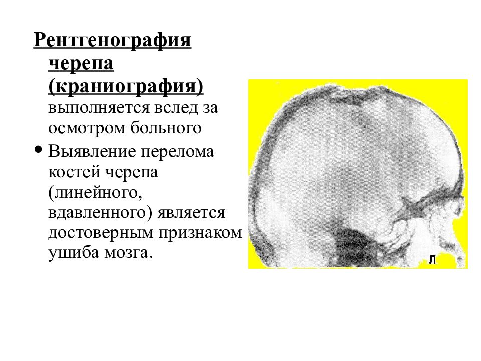 Черепно мозговая травма презентация травматология