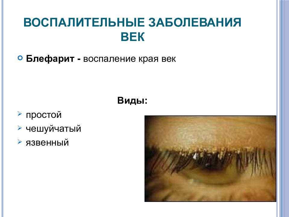 Лечение заболеваний век. Блефарит (воспаление края век). Блефарит век чешуйчатый. Инфекционный язвенный блефарит.