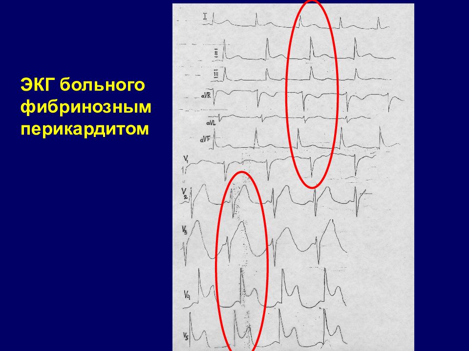 Экг при перикардите в картинках
