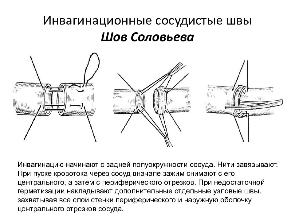 Сосудистый шов