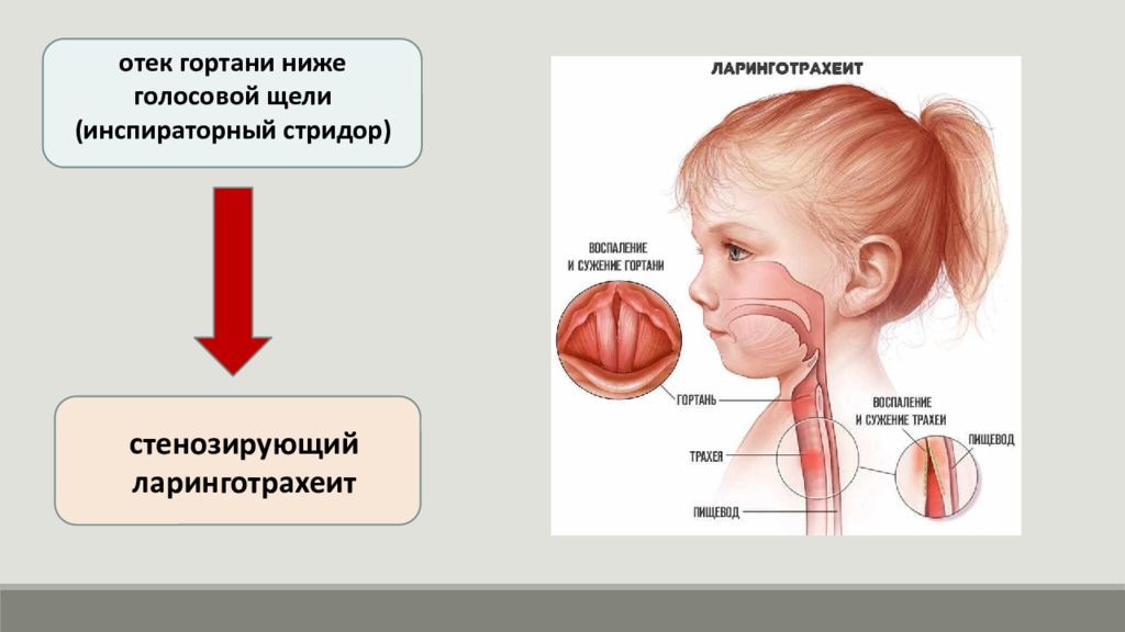 Острая дыхательная недостаточность у детей презентация