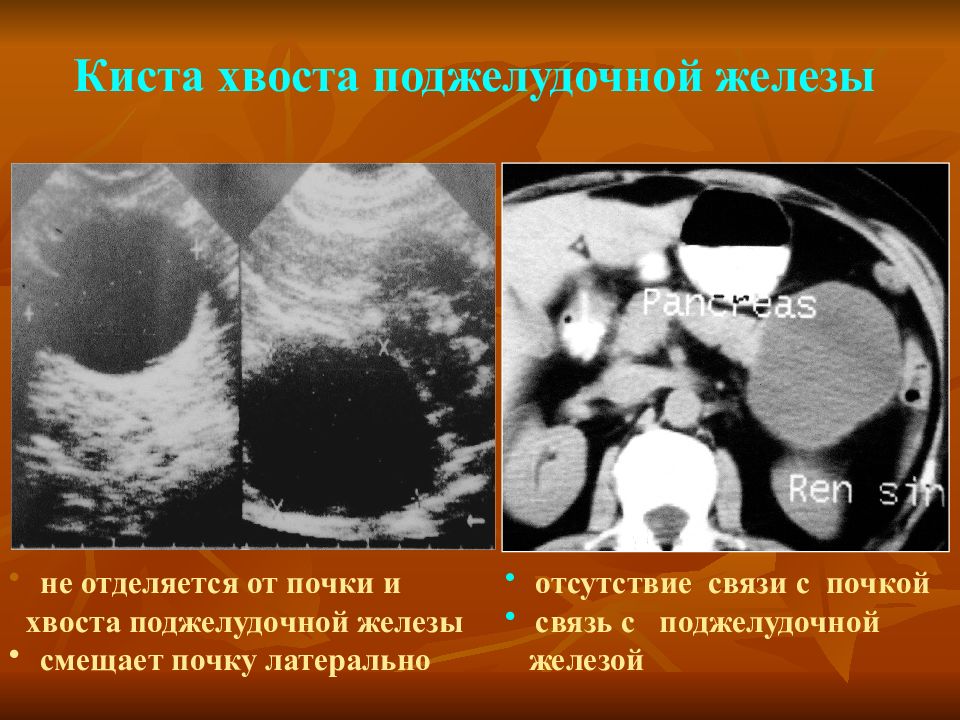 Поджелудочная киста операция