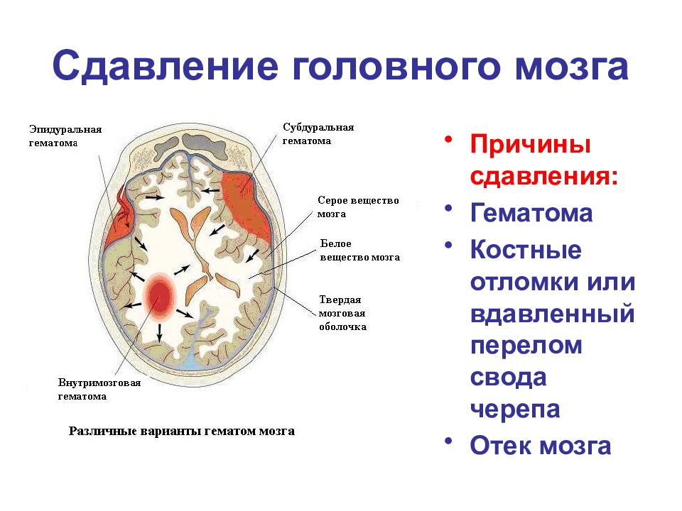 Внутренние признаки головного мозга. Сдавление головного мозга. Причины сдавления головного мозга. Сдавление головного мозга гематомой. Сжатие головного мозга.