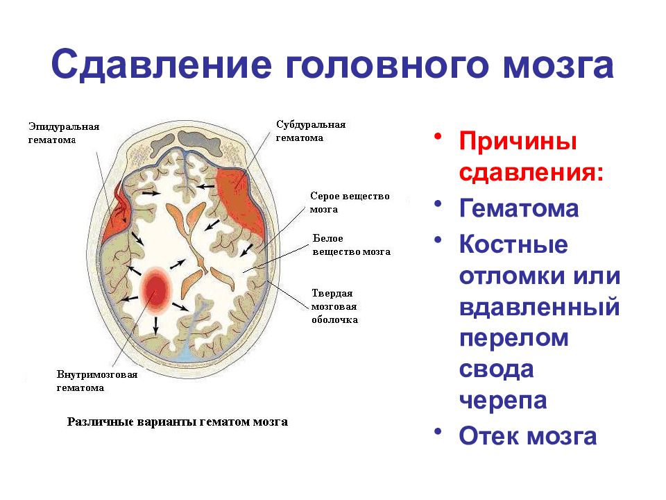 Сдавление головного мозга гематомой. Сдавление головного мозга. Причины сдавления головного мозга. Сдавление головного мозга ЧМТ.