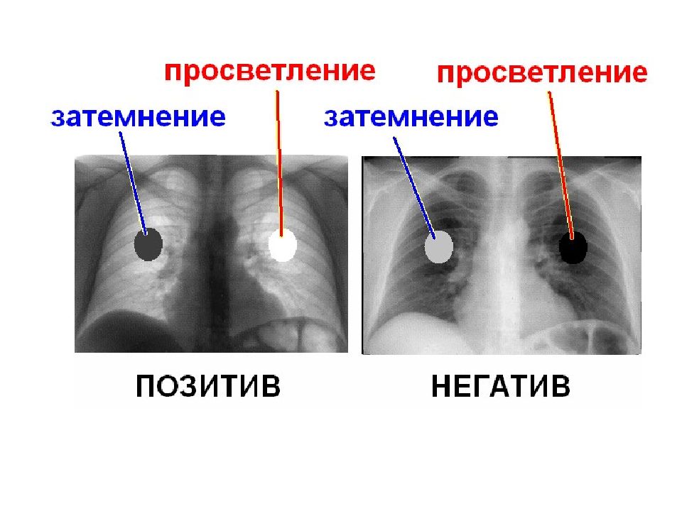 Негативное изображение рентген