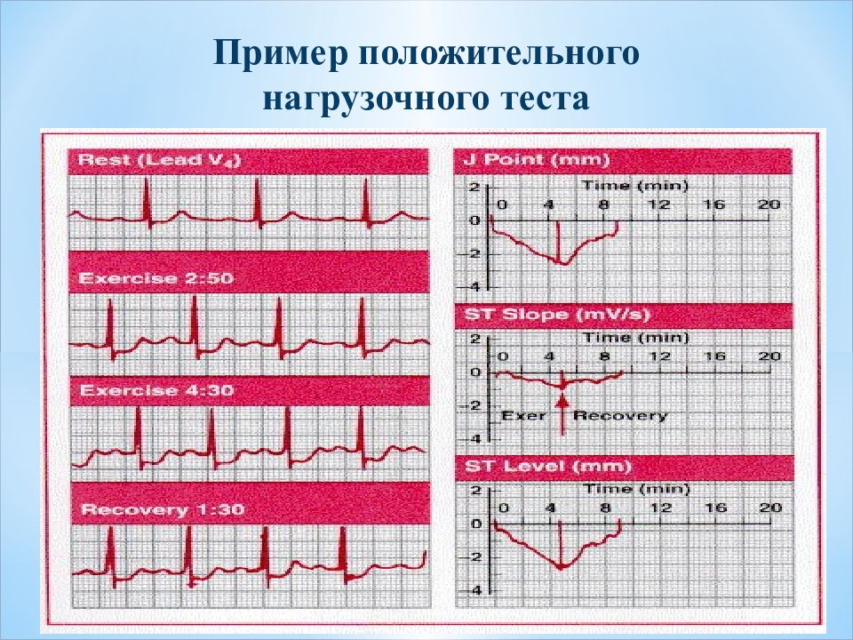 Журнал ультразвуковая и функциональная диагностика. Нагрузочные тесты. Методы функциональной диагностики. Тест: "функциональная диагностика 1 категория".. Положительный нагрузочный тест.