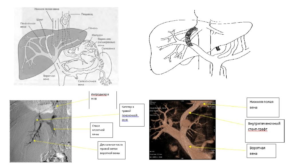 Две нижних полых вены. Воротная Вена анатомия схема. Тромбоз воротной вены на кт. Ветви воротной вены кт.