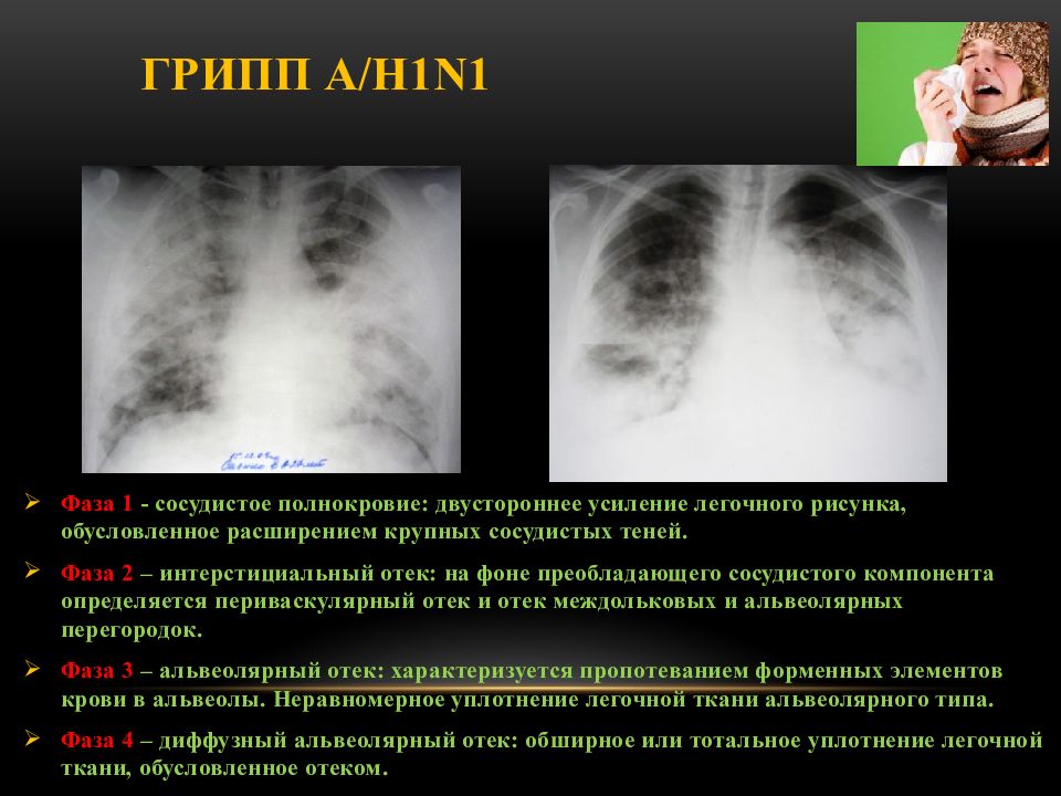 Усилен сосудистый компонент легочного рисунка. Легочный рисунок усилен за счет сосудистого компонента. Легочный рисунок диффузно усилен. Усиление легочного рисунка за счет интерстициального компонента. Усиление легочного рисунка сосудистого компонента.