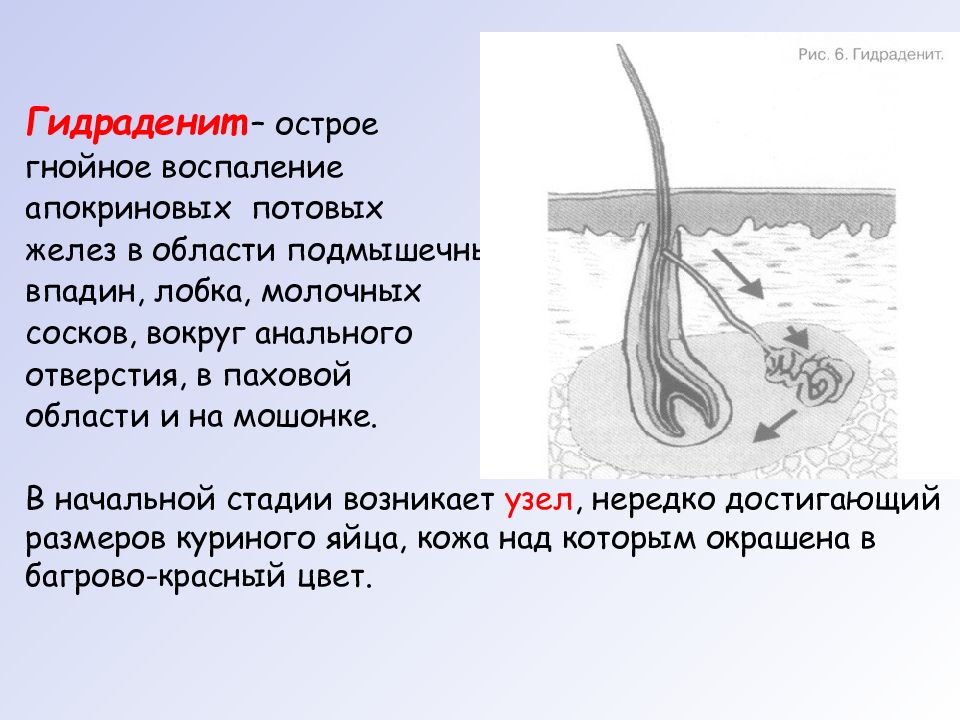 Потовой проток. Гнойное воспаление апокриновых потовых желез. Воспаление потовой железы в подмышки. Гидраденит потовых желез.