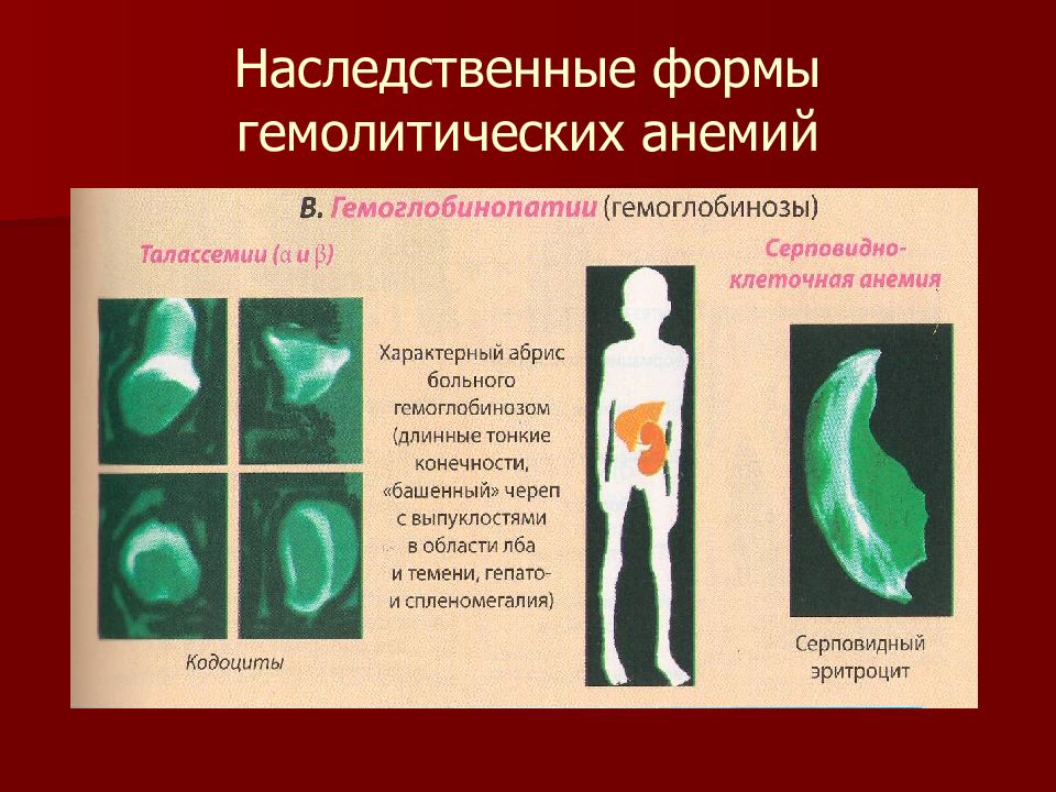 Анемия гемоглобинопатия